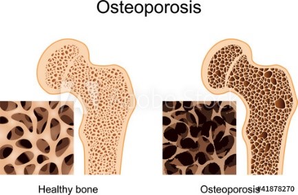 Fast&Up Osteoporosis